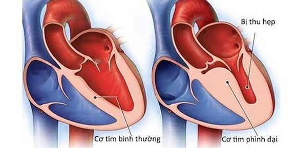 Tim thất phải và viêm cơ tim