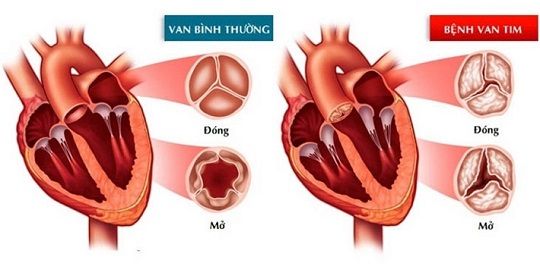 Bệnh van tim: Nguyên nhân, dấu hiệu, triệu chứng và cách điều trị