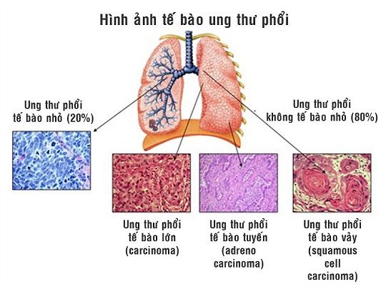 Ung thư phổi tế bào nhỏ và không tế bào nhỏ