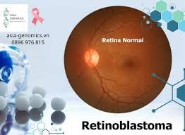 Tổng hợp thuốc và hoạt chất điều trị U Nguyên Bào Võng Mạc