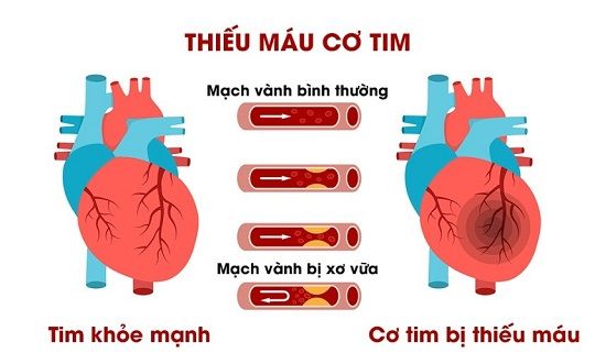 Bệnh thiếu máu cơ tim