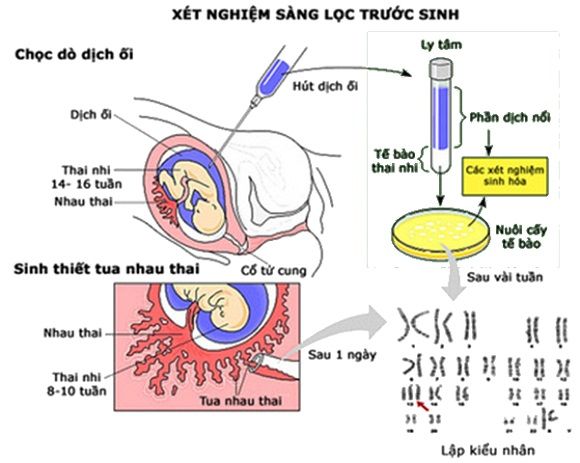 Xét nghiệm sàng lọc trước sinh