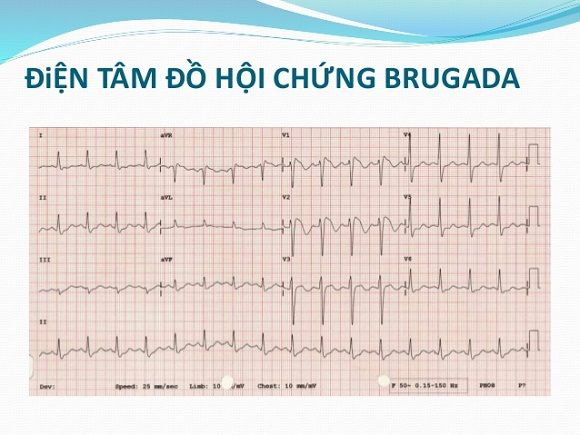 Hội chứng Brugada