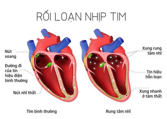 Rối loạn nhịp tim: Nguyên nhân, dấu hiệu, triệu chứng và phòng ngừa