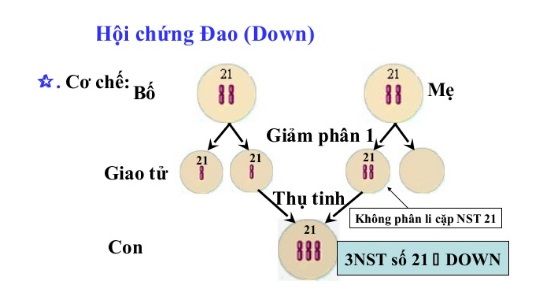 Hội chứng Down là gì