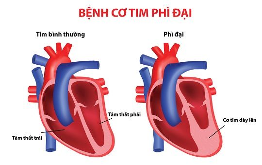 Bệnh cơ tim phì đại biến chứng nguy hiểm như thế nào?