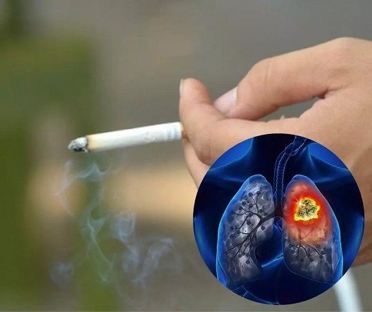 Nhóm người bị ung thư phổi