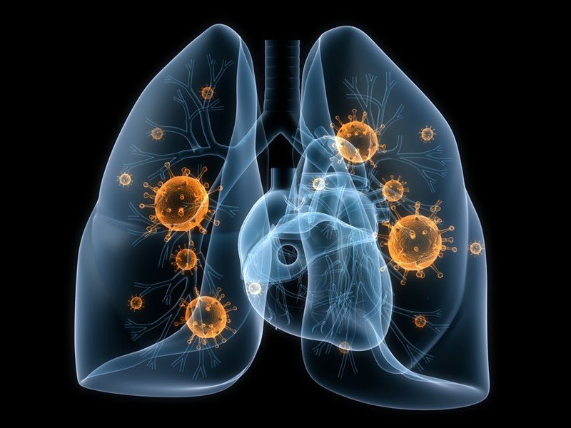 Ung thư phổi không tế bào nhỏ